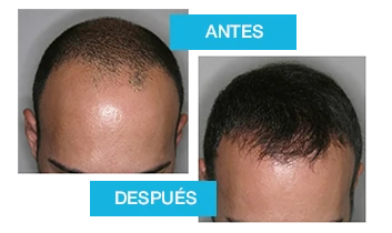 Resultados antes y después del tratamiento con Profolan para la caída del cabello